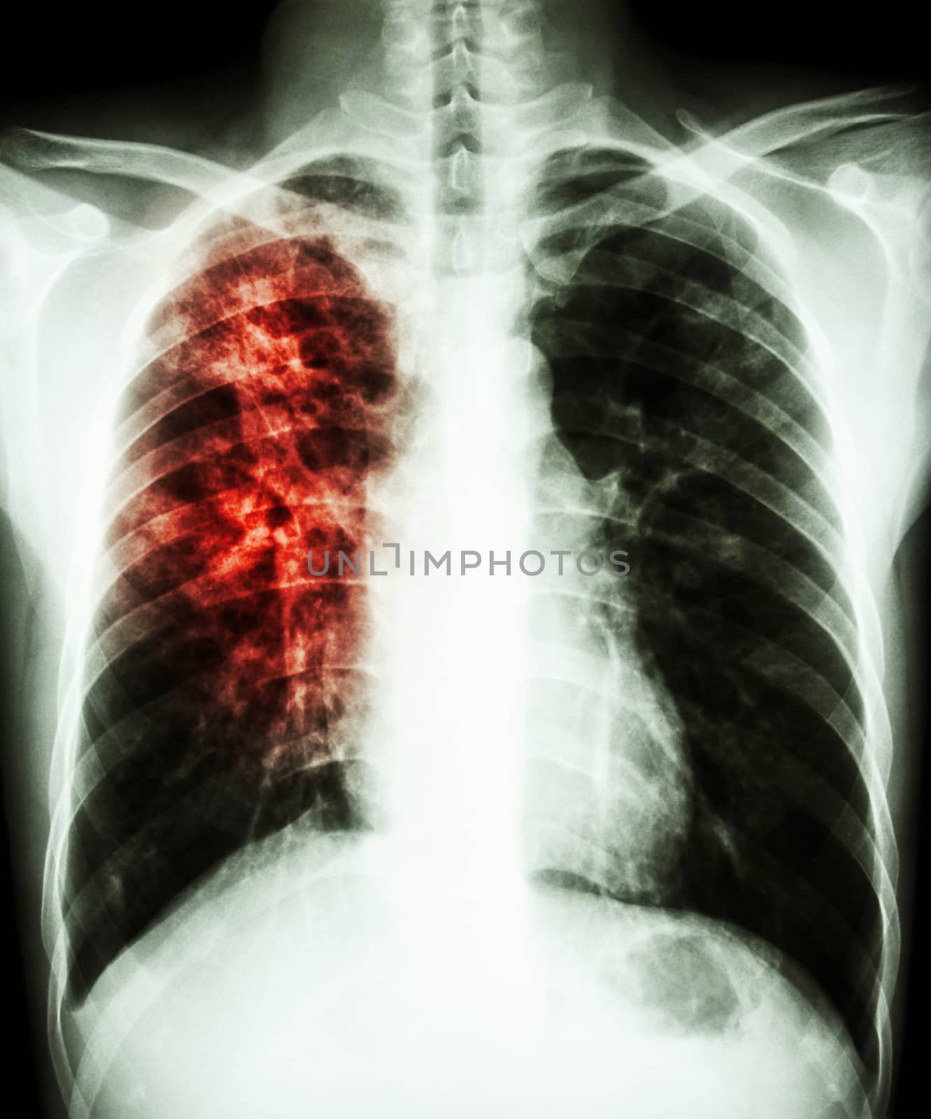 film chest x-ray PA upright : show interstitial infiltration at right lung due to mycobacterium tuberculosis infection (Pulmonary tuberculosis)