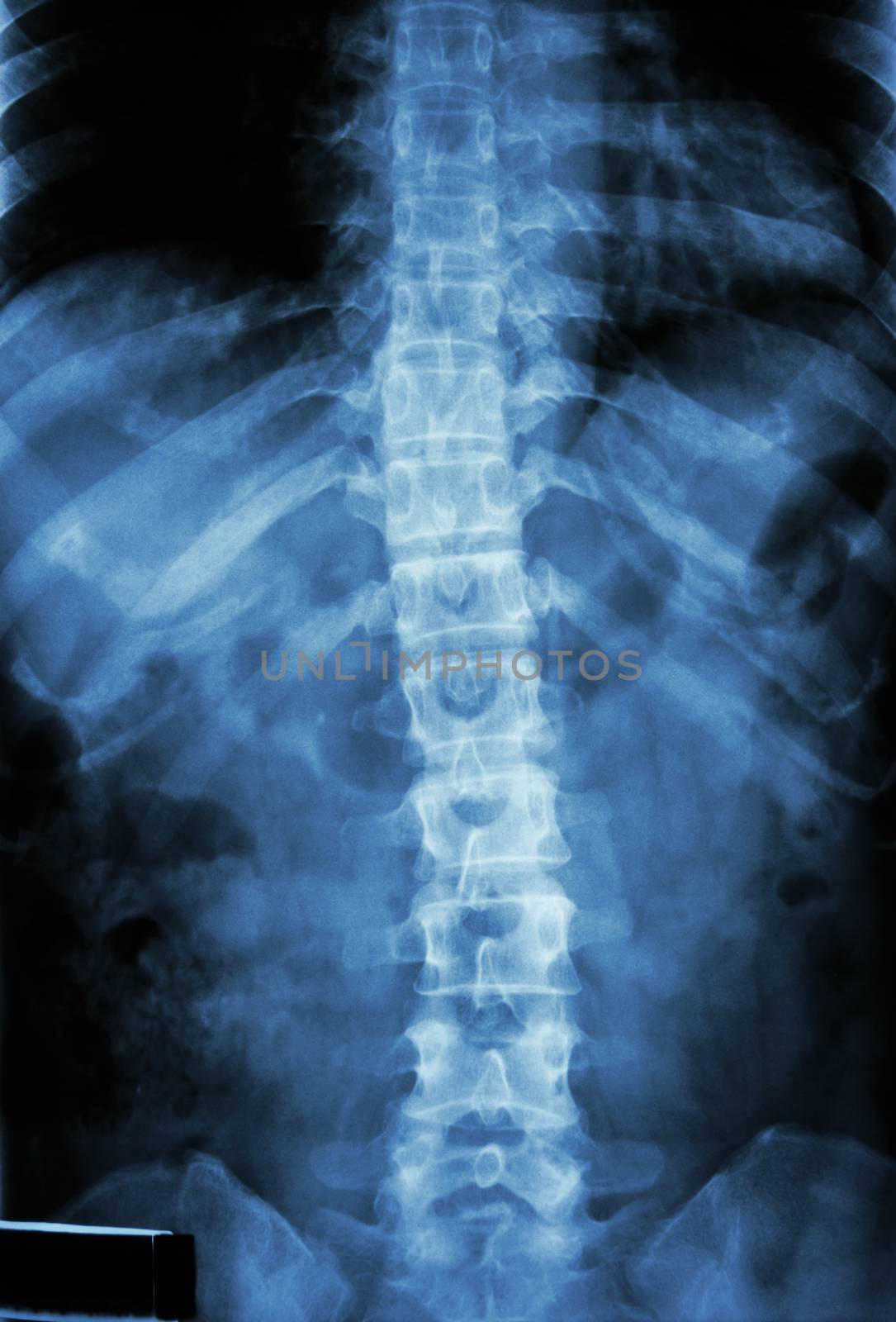 film x-ray T-L spine(Thoracic-Lumbar spine) show : normal human's thoracic-lumbar spine