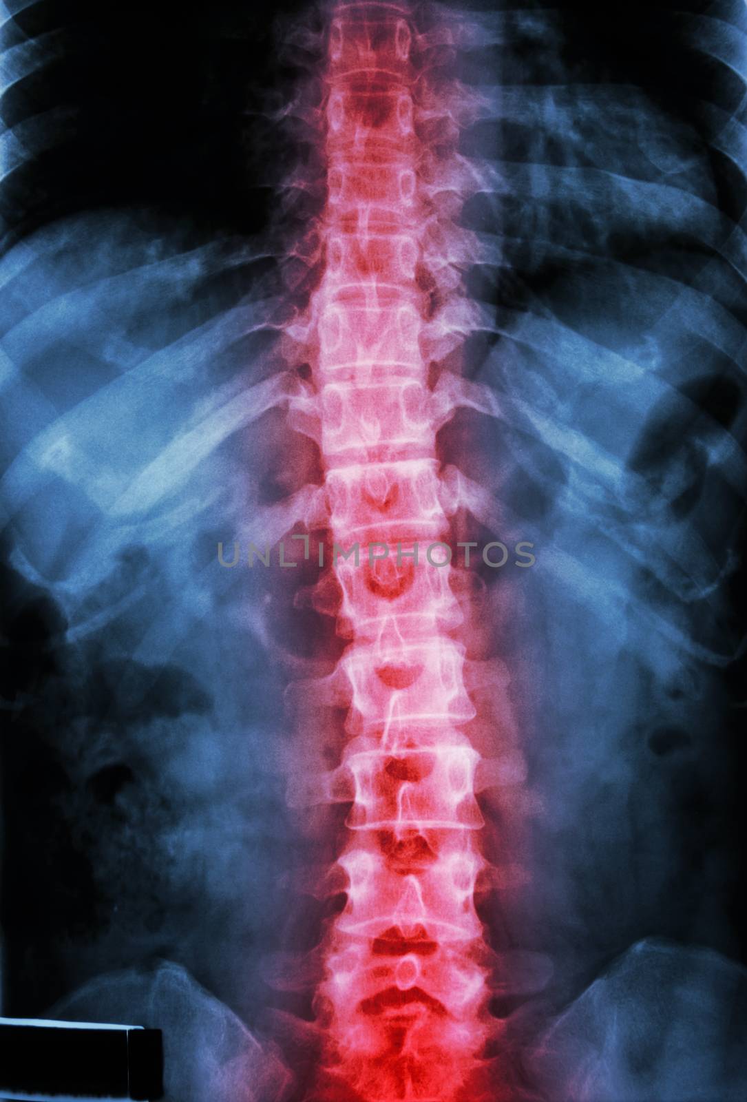 film x-ray T-L spine(Thoracic-Lumbar spine) show : human's thoracic-lumbar spine and inflammation at spine