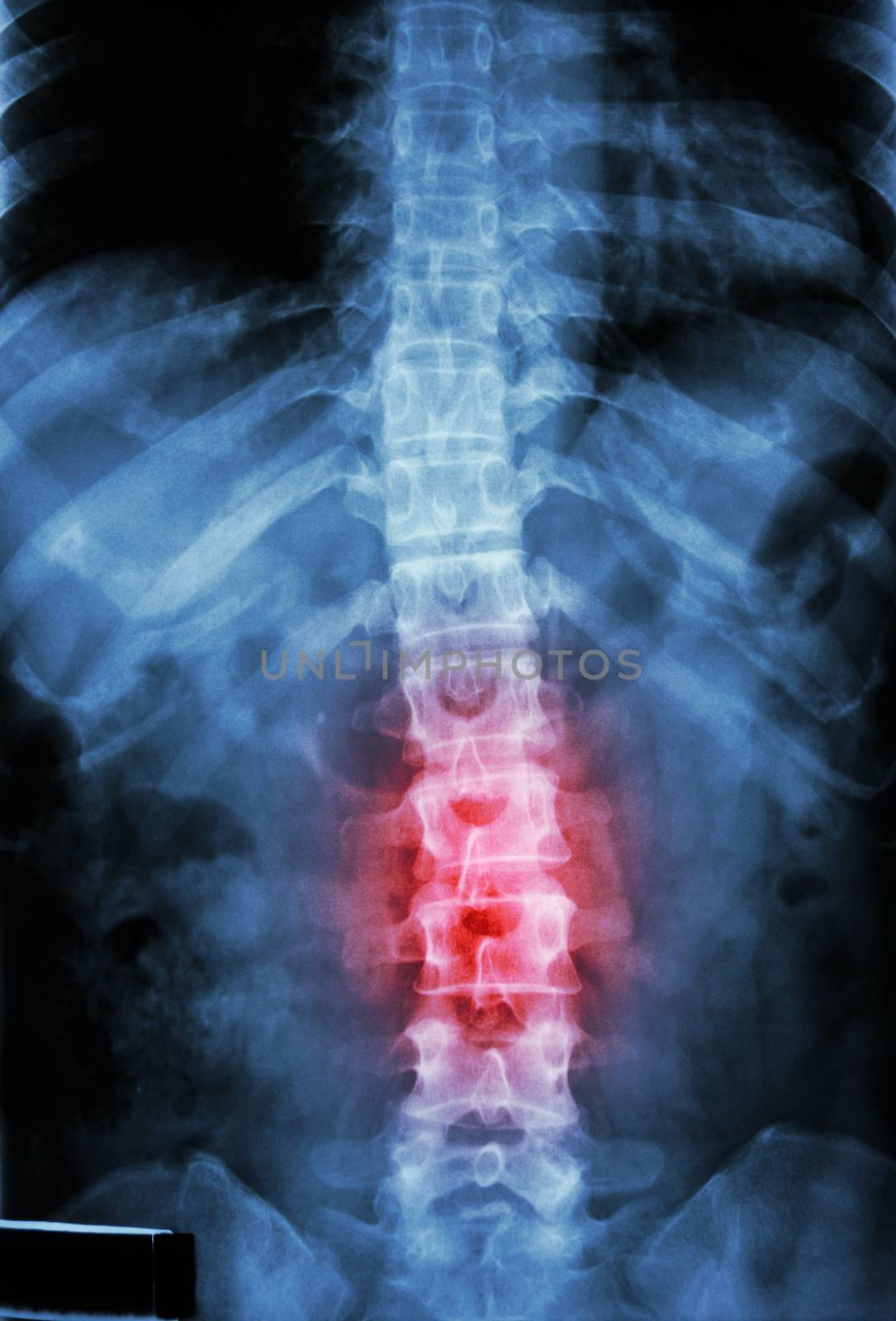 film x-ray T-L spine(Thoracic-Lumbar spine) show : human's thoracic-lumbar spine and inflammation at lumbar spine by stockdevil