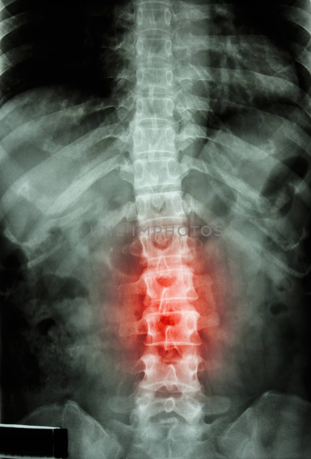 film x-ray T-L spine(Thoracic-Lumbar spine) show : human's thoracic-lumbar spine and inflammation at lumbar spine by stockdevil