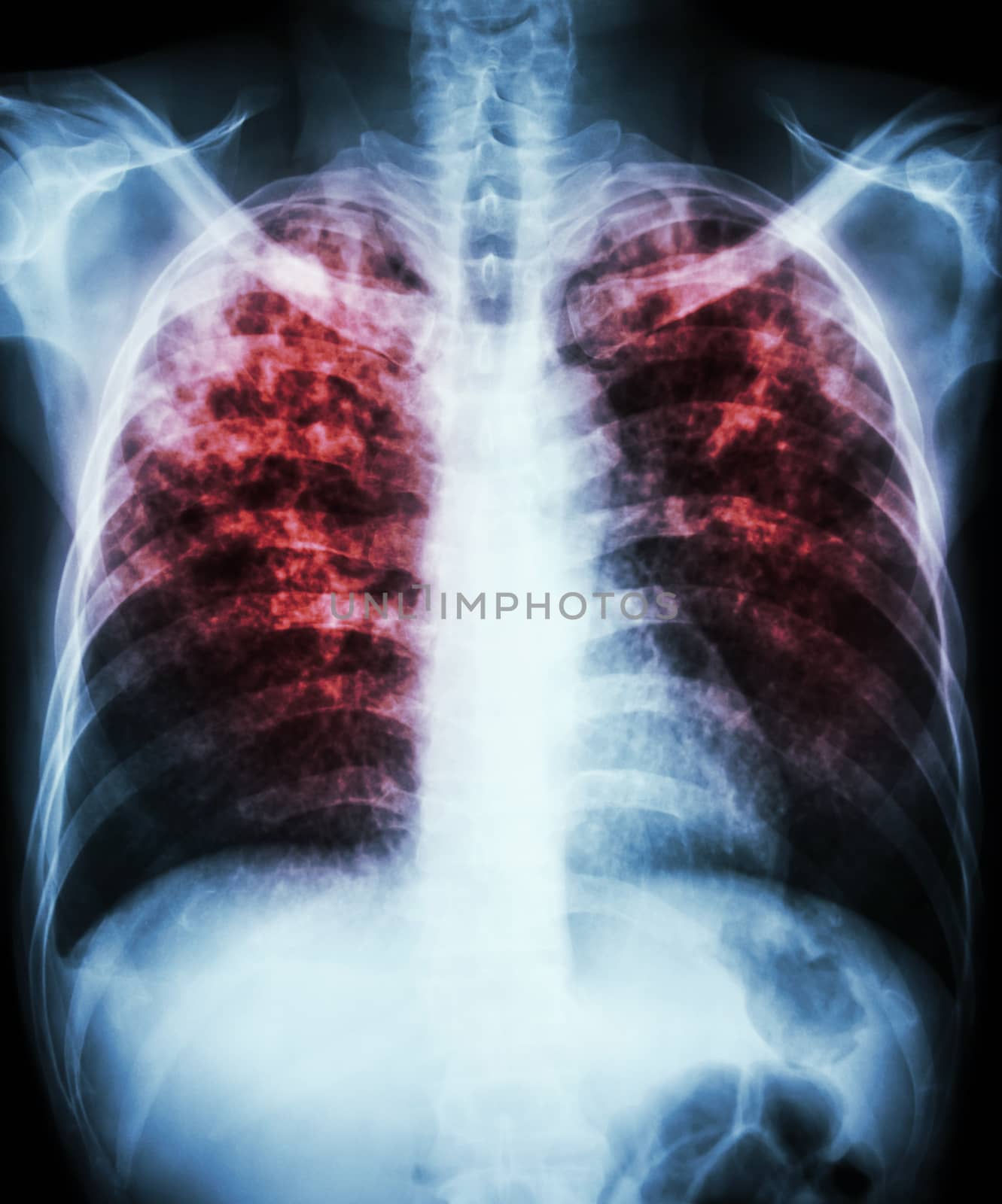 "Pulmonary tuberculosis" Film chest x-ray show interstitial infiltration both lung due to mycobacterium tuberculosis infection