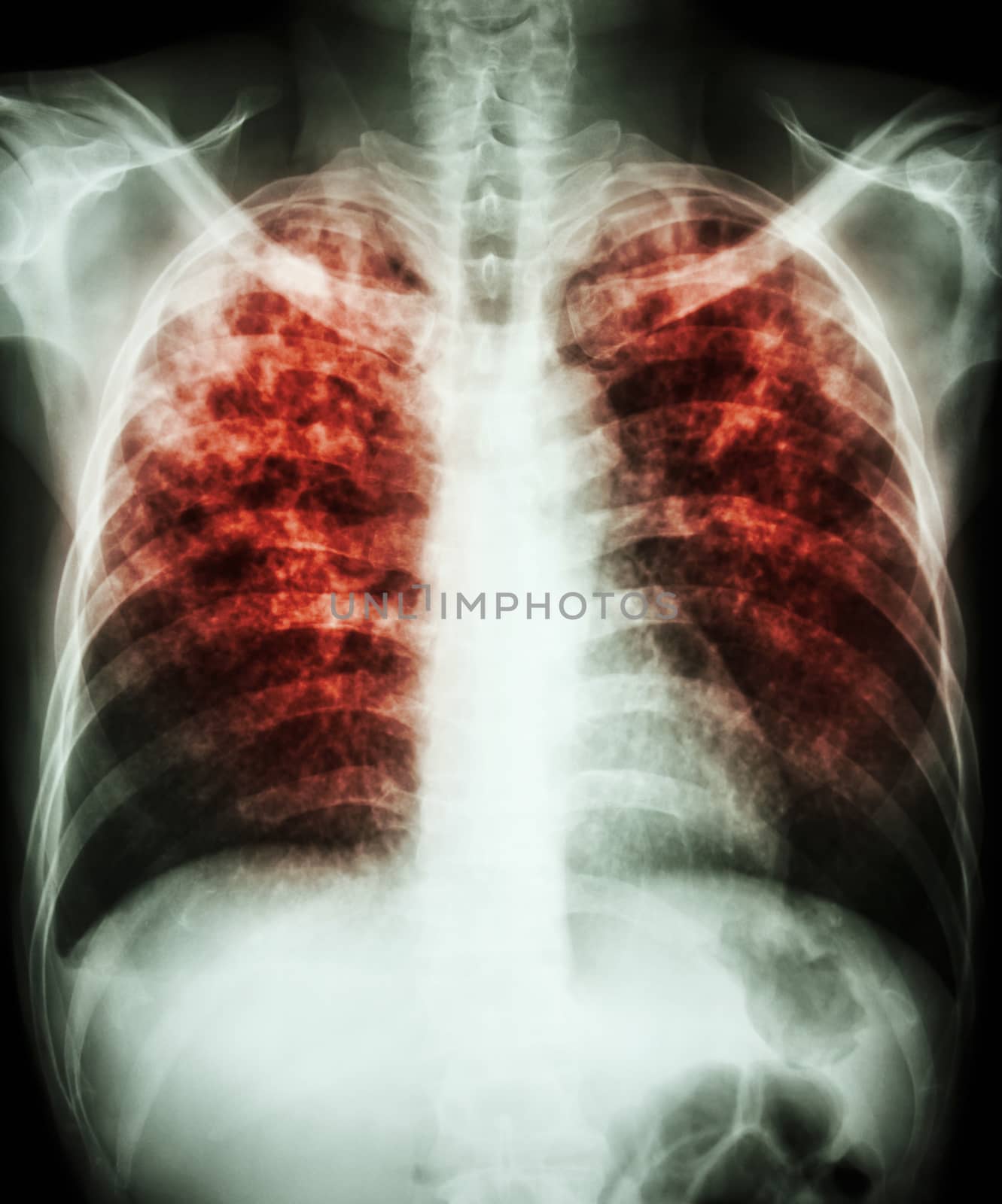 "Pulmonary tuberculosis" Film chest x-ray show interstitial infiltration both lung due to mycobacterium tuberculosis infection