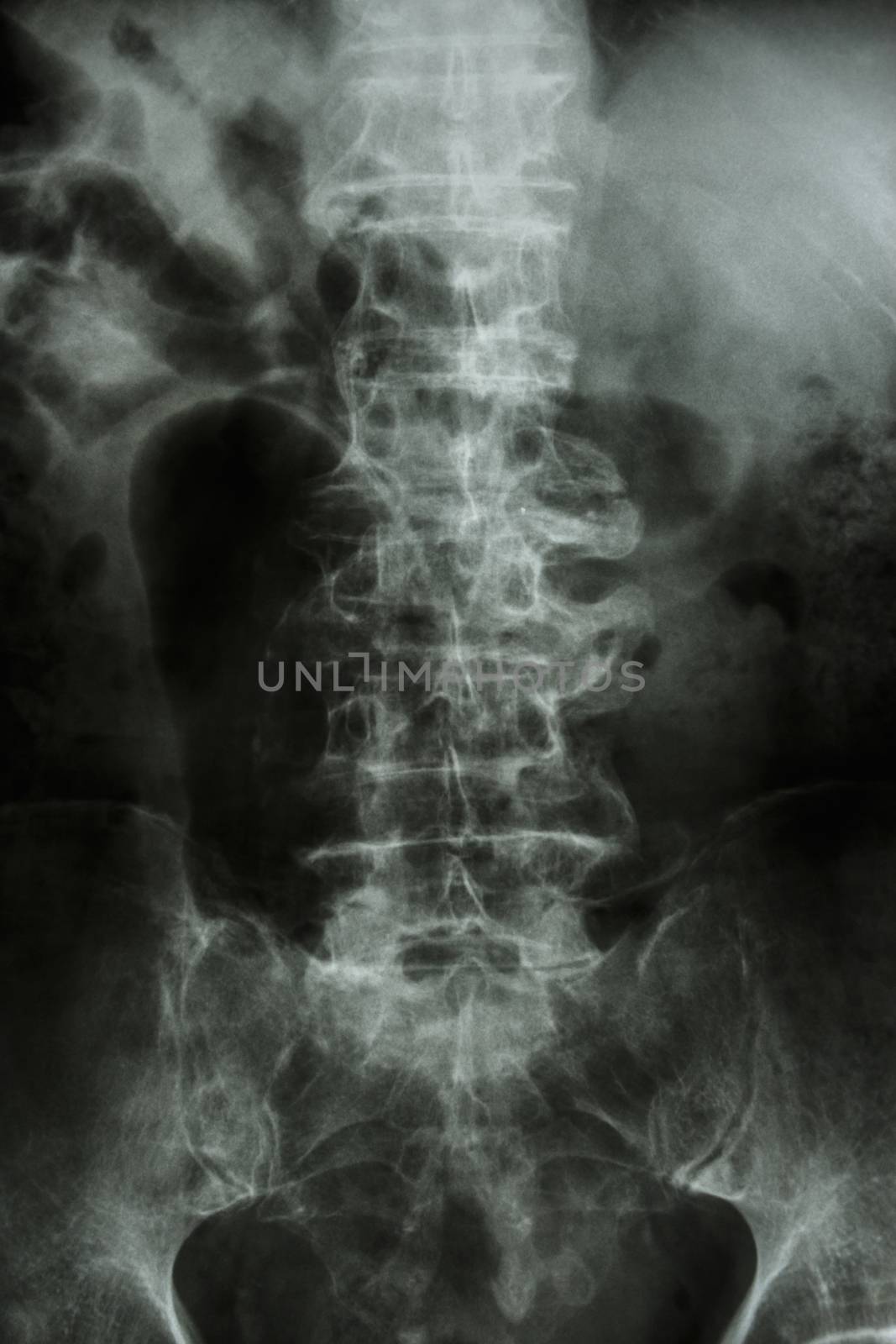 "Spondylosis" Film x-ray : lumbar spine with spur & collapse at body of spine