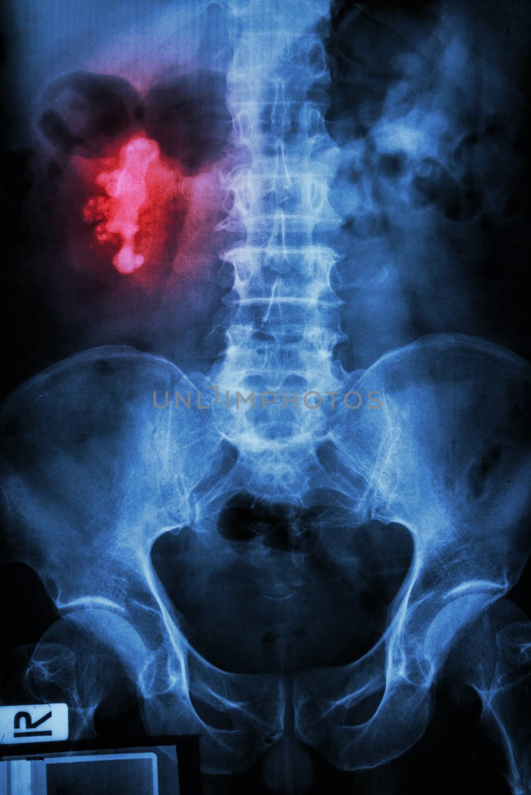 right renal calculi (staghorn) by stockdevil