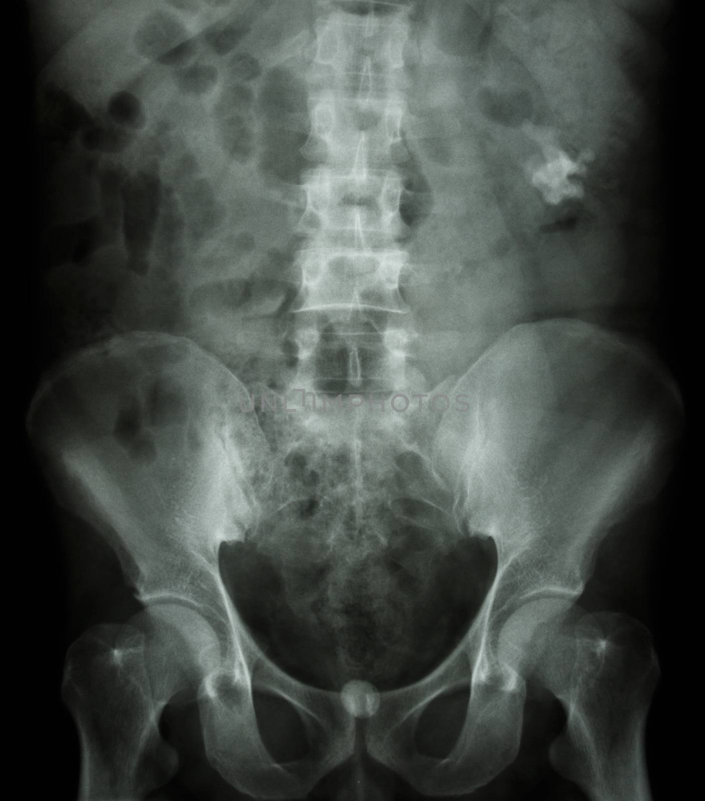 Left kidney stone(opaque area at right upper of image) and bladder stone(opaque area at lower of image)