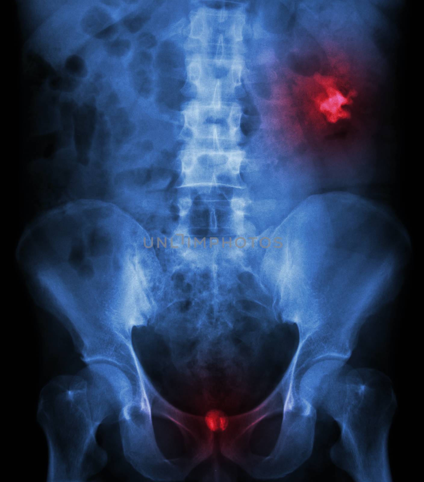 Left kidney stone(opaque area at right upper of image) and bladder stone(opaque area at lower of image)