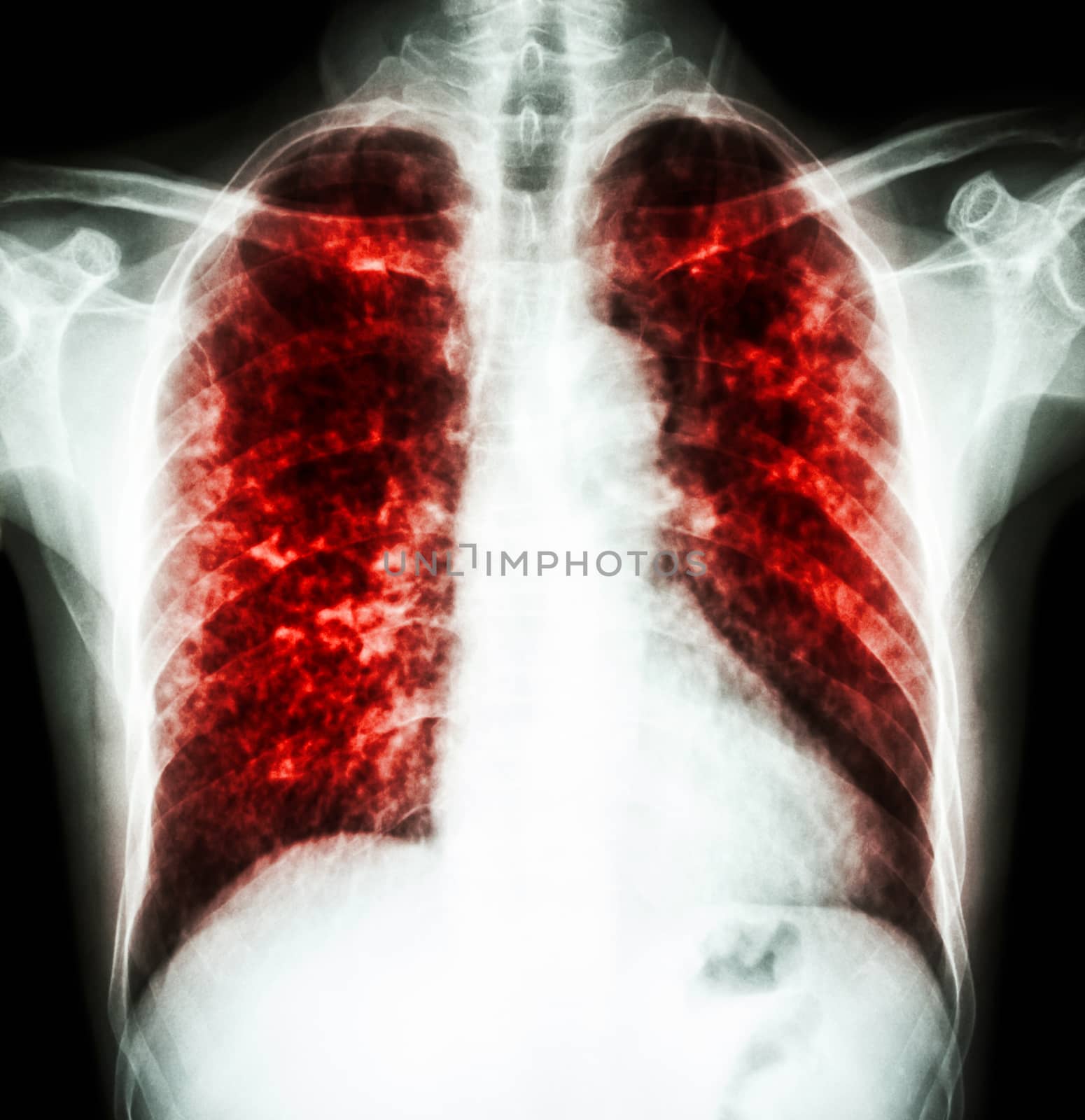 Pulmonary Tuberculosis by stockdevil