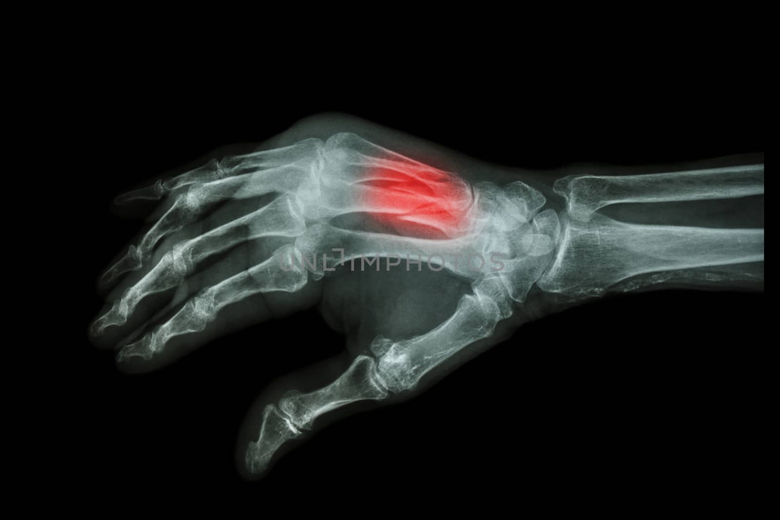 Film X-ray hand oblique : Fracture at 3rd and 4th metacarpal bone