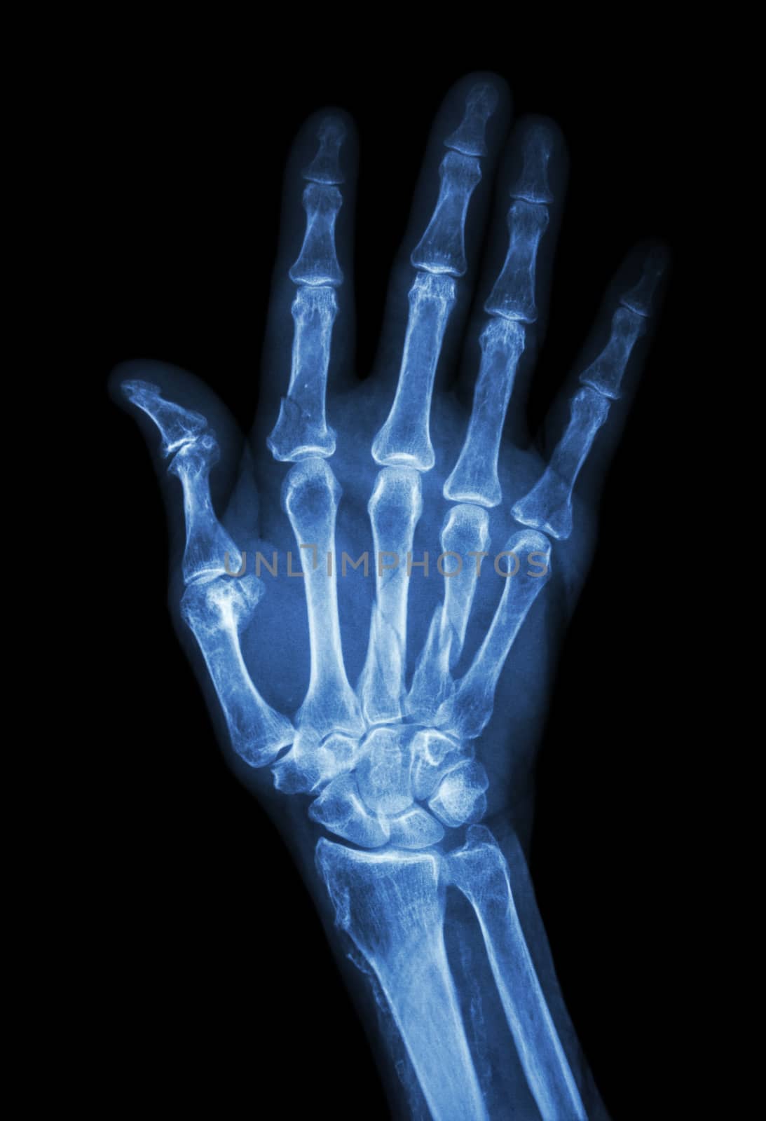 Multiple fracture at index,little finger,metacarpal bone by stockdevil