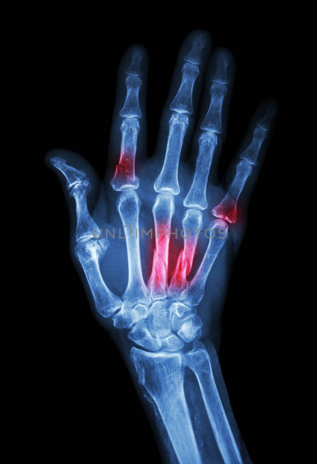 Multiple fracture at index,little finger,metacarpal bone by stockdevil