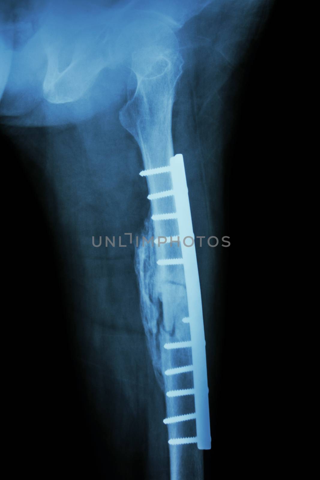 Fracture shaft of femur. It was operated and internal fixation b by stockdevil