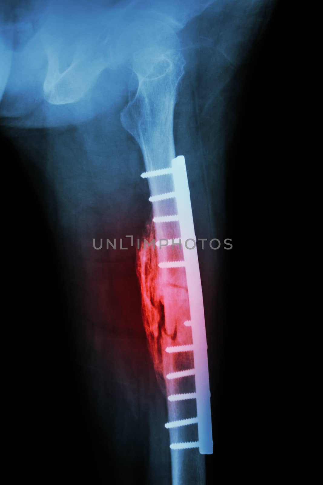 Fracture shaft of femur. It was operated and internal fixation b by stockdevil