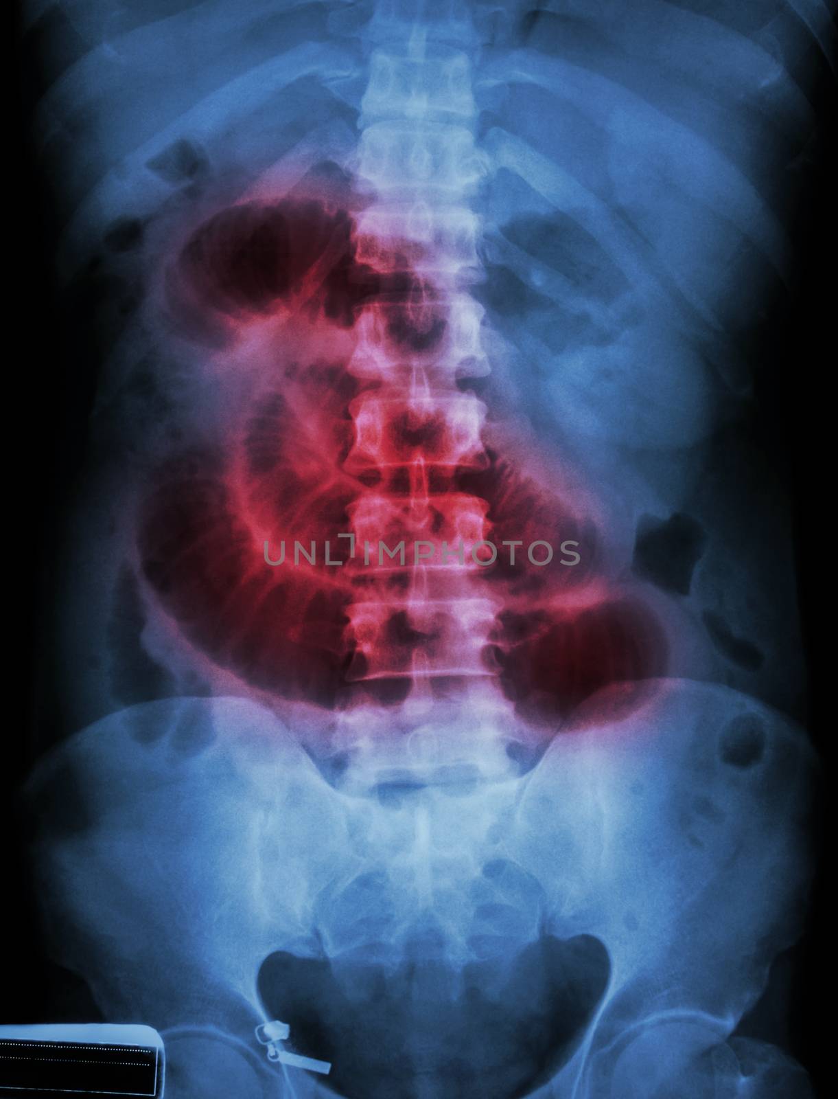 "Small intestine obstruction" Film X-ray abdomen supine : Show by stockdevil