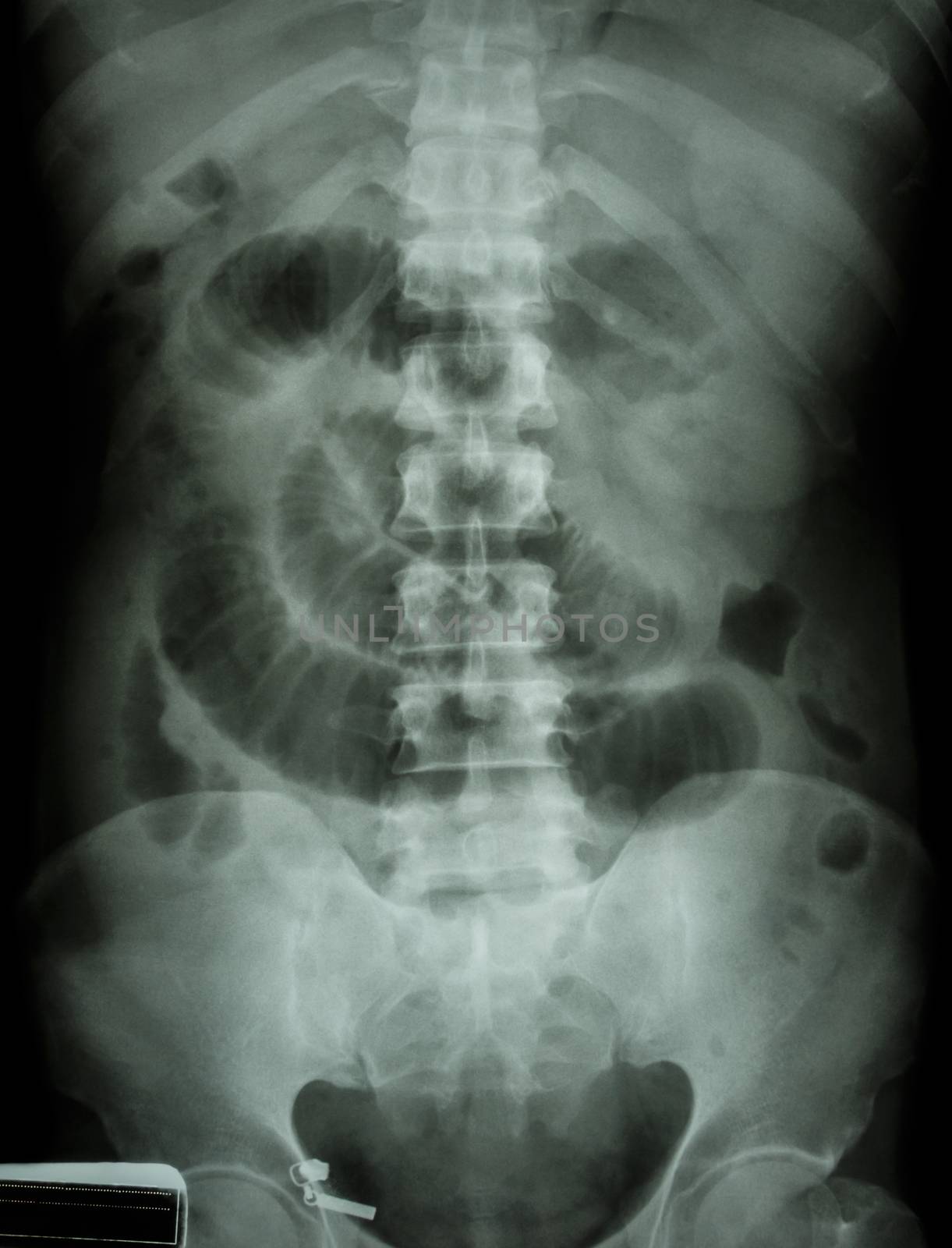 "Small intestine obstruction" Film X-ray abdomen supine : Show small intestine dilate