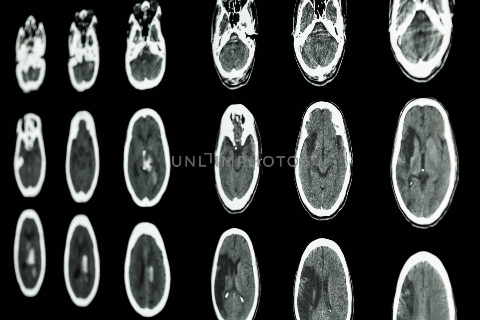 film CT scan of brain show ischemic stroke and hemorrhagic strok by stockdevil