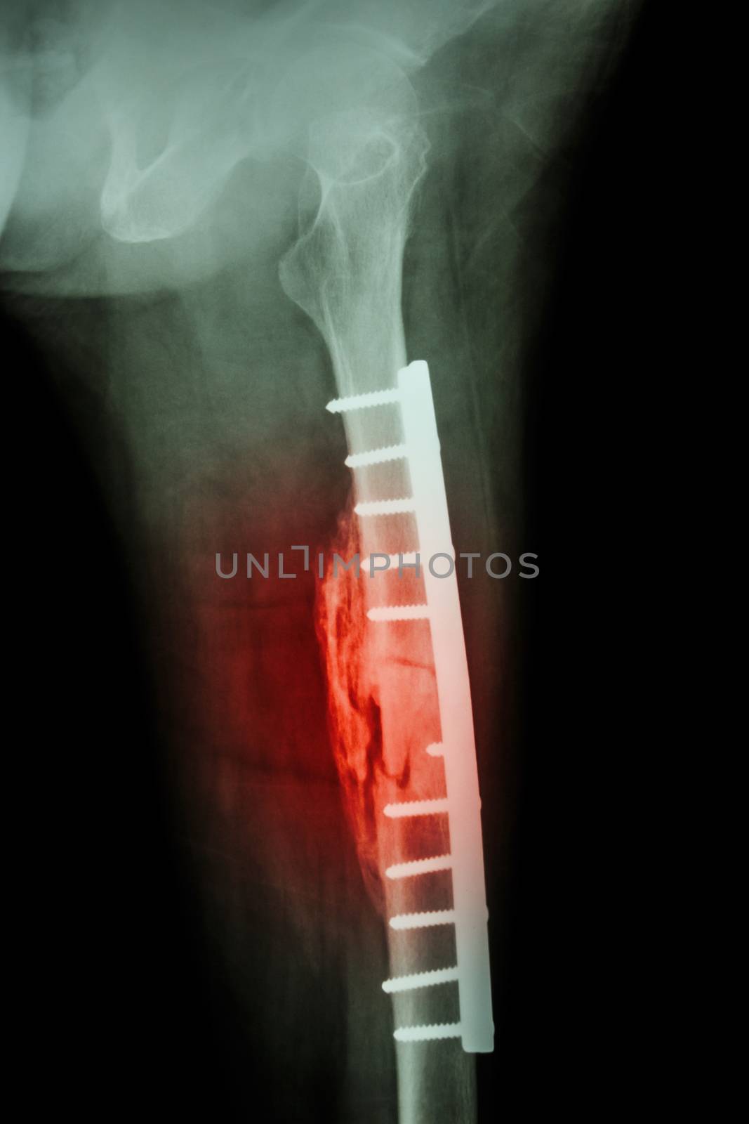 Fracture shaft of femur. It was operated and internal fixation by plate & screw