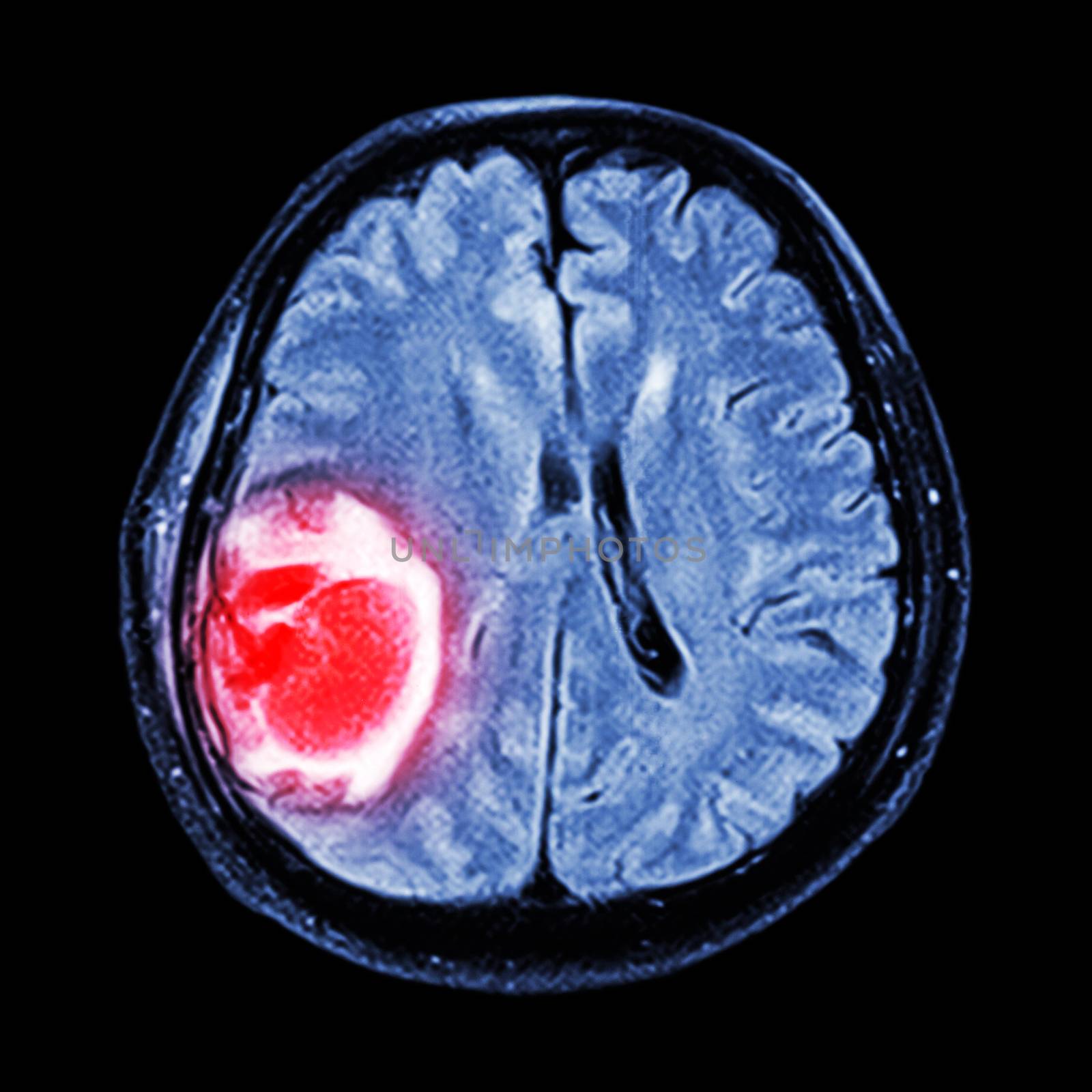 MRI brain : show brain tumor at right parietal lobe of cerebrum by stockdevil