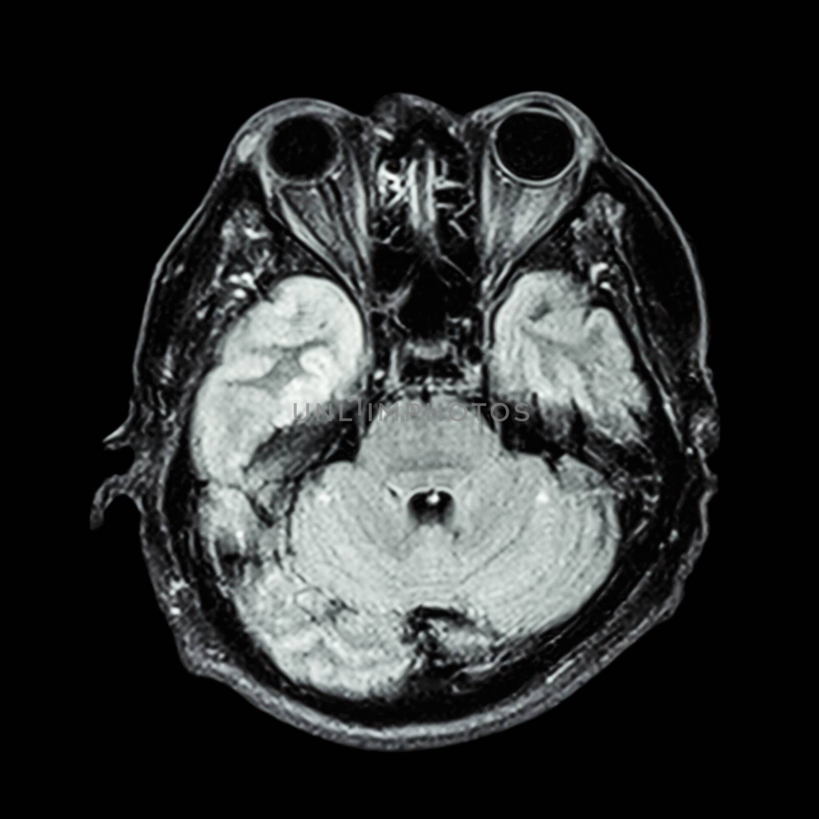 MRI brain : show lower part of brain(cerebellum,temporal lobe of by stockdevil