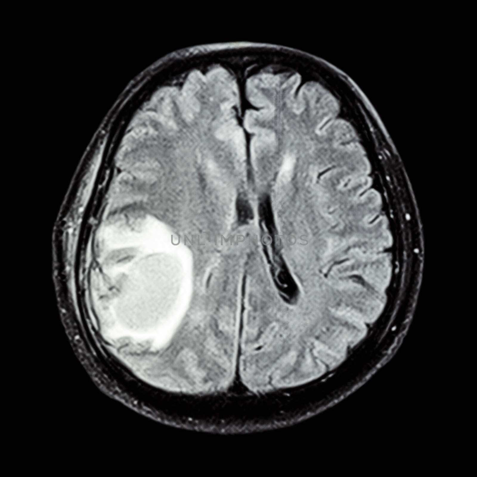 MRI brain : show brain tumor at right parietal lobe of cerebrum by stockdevil