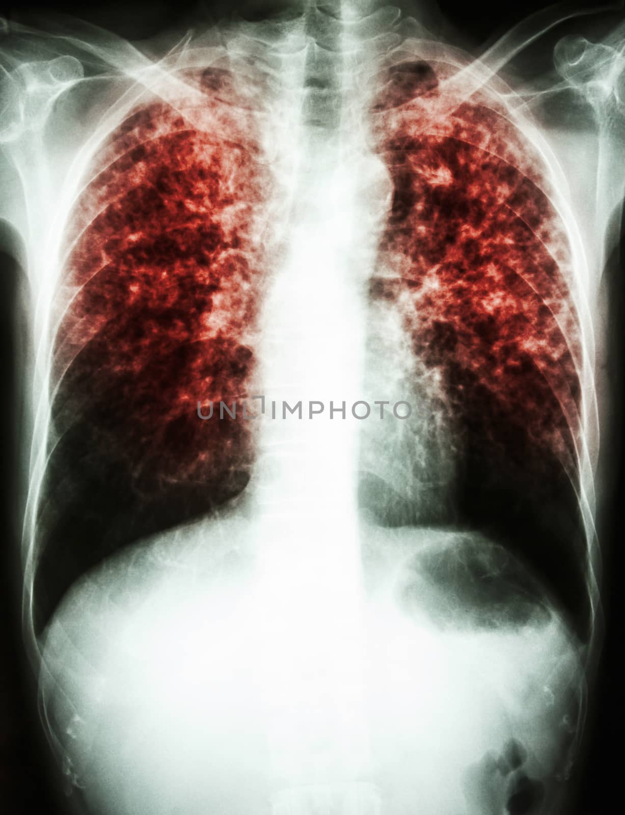 Mycobacterium tuberculosis infection (Pulmonary Tuberculosis) by stockdevil