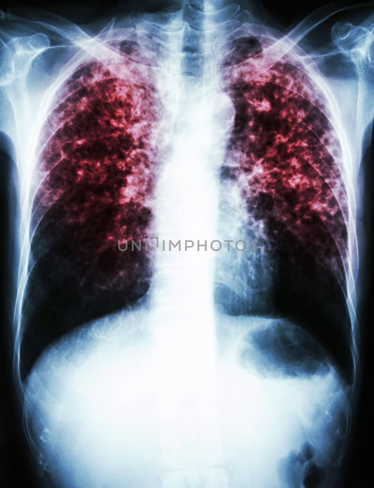 film chest x-ray show interstitial infiltrate both lung due to Mycobacterium tuberculosis infection (Pulmonary Tuberculosis)