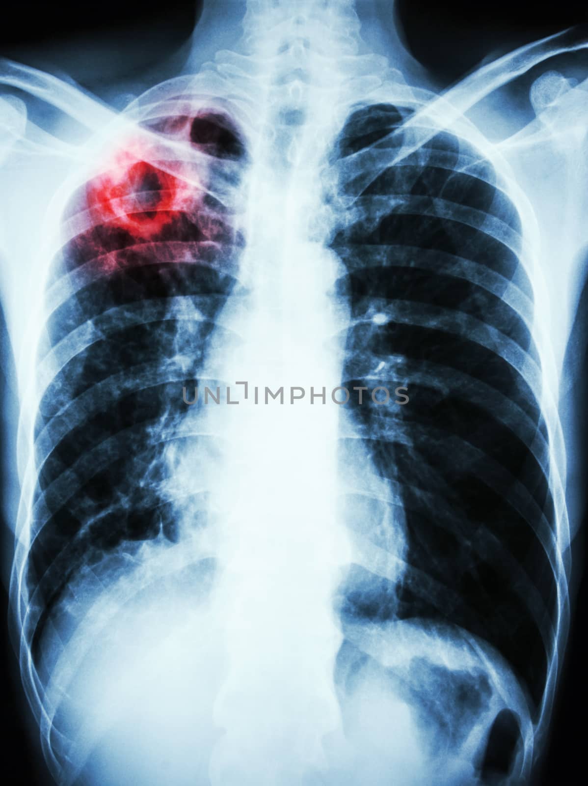 film chest x-ray show cavity at right upper lung due to Mycobacterium tuberculosis infection (Pulmonary Tuberculosis)