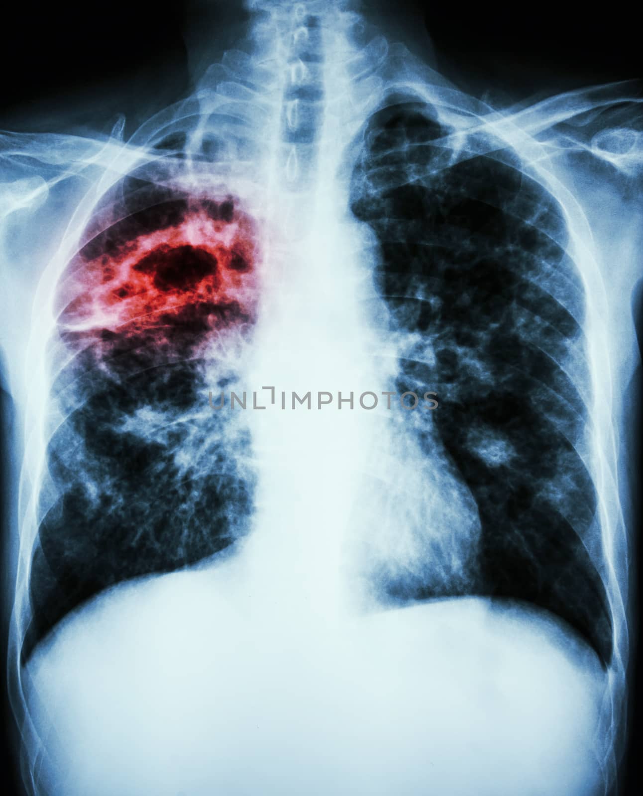 film chest x-ray show cavity at right lung,fibrosis & interstitial & patchy infiltrate at both lung due to Mycobacterium tuberculosis infection (Pulmonary Tuberculosis)