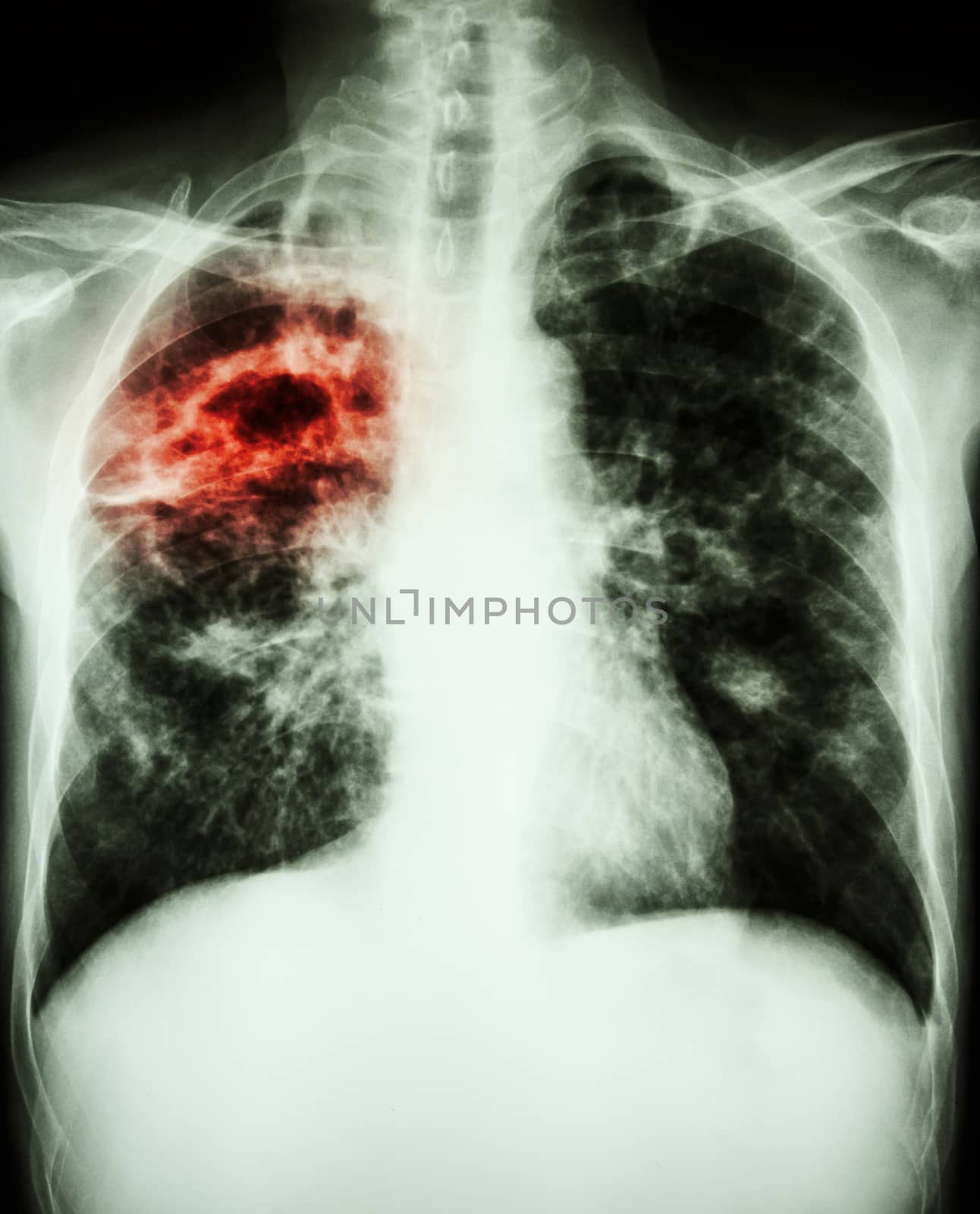 Mycobacterium tuberculosis infection (Pulmonary Tuberculosis) by stockdevil