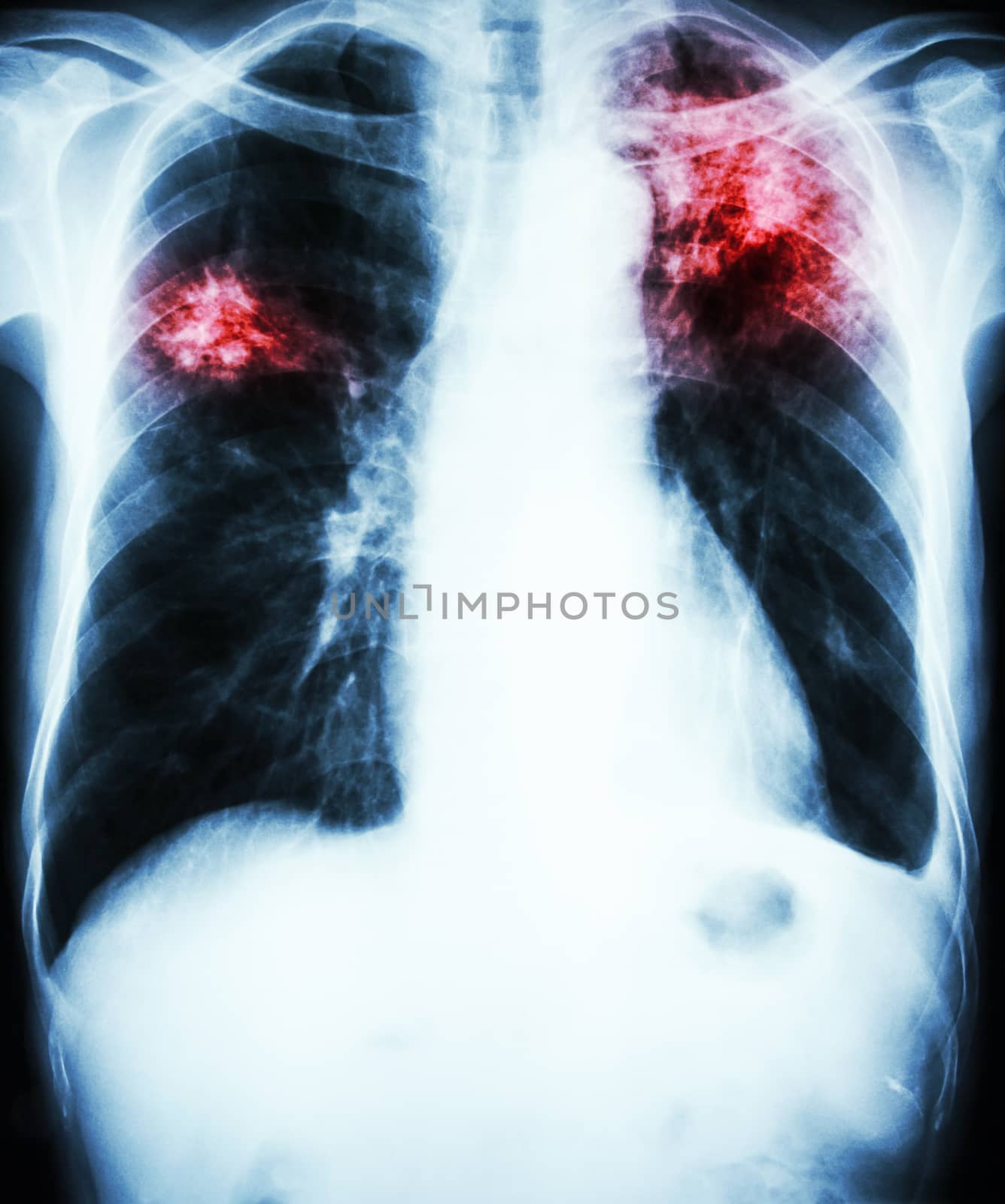Pulmonary Tuberculosis by stockdevil