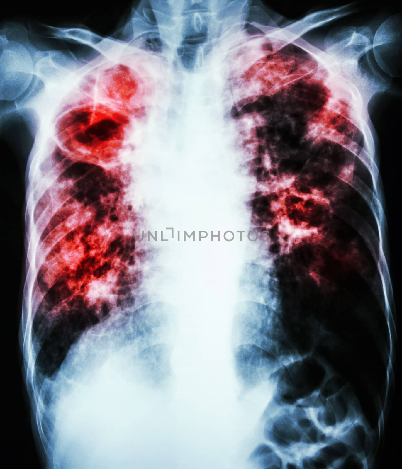 film chest x-ray show cavity at right lung,fibrosis & interstitial & patchy infiltrate at both lung due to Mycobacterium tuberculosis infection (Pulmonary Tuberculosis)