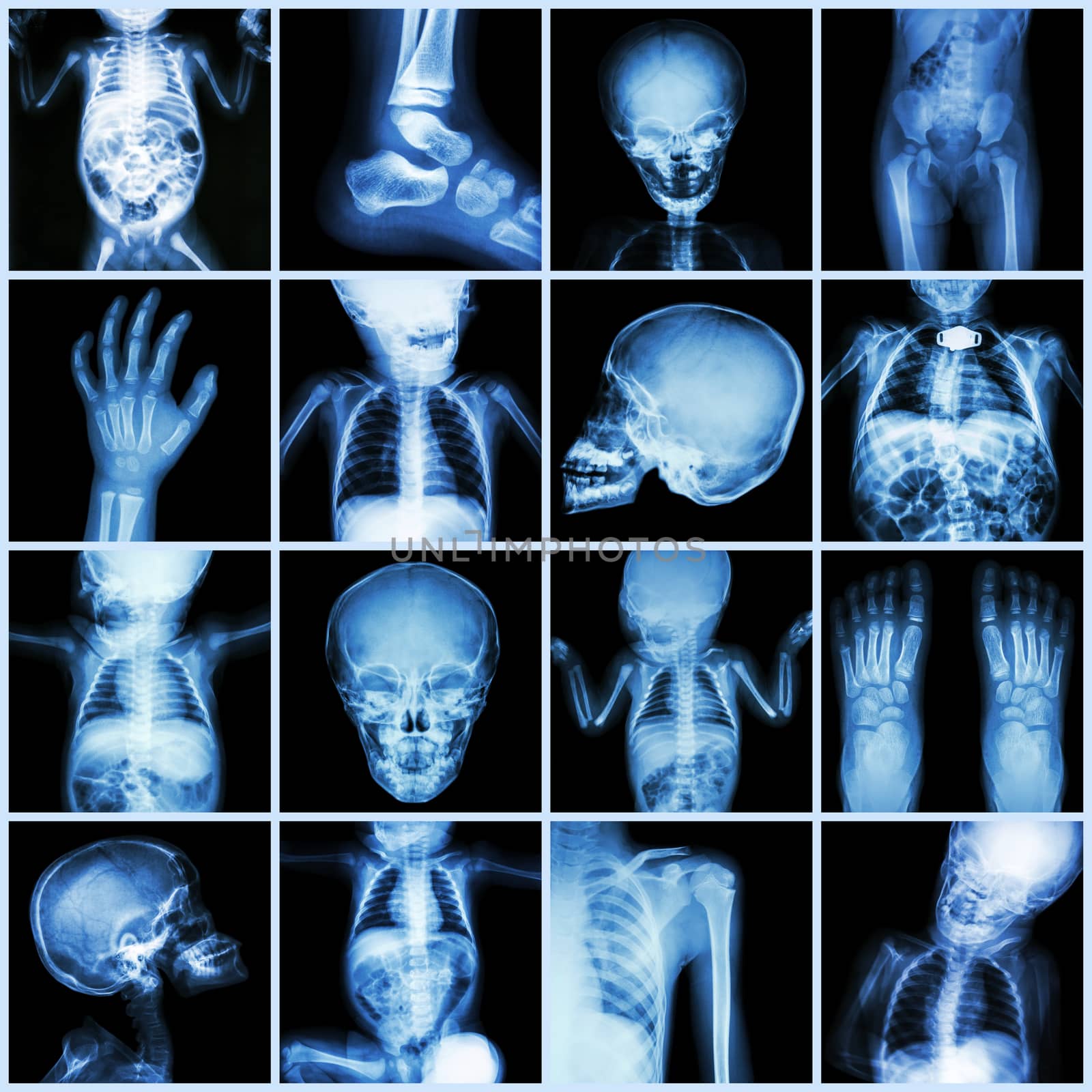 Collection X-ray part of child body ( Whole body : skull head neck face spine shoulder chest thorax lung heart abdomen arm elbow forearm hip pelvis thigh leg foot hand wrist ankle joint intestine etc) by stockdevil