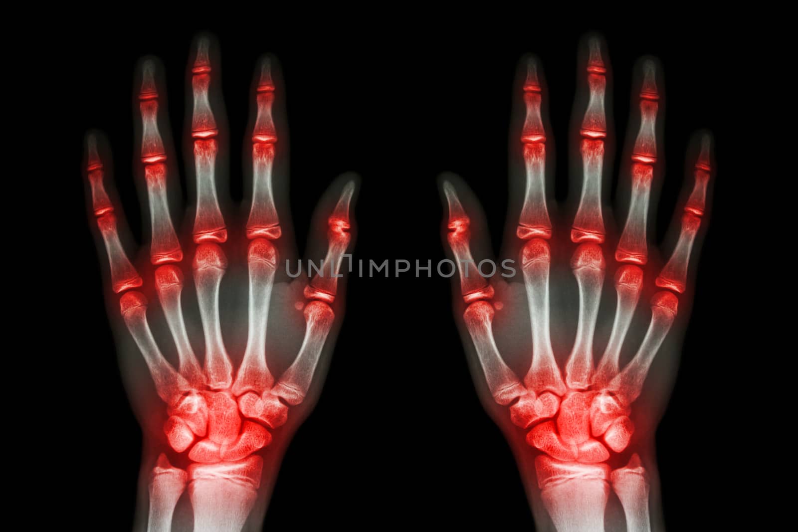 multiple joint arthritis both hands ( Gout , Rheumatoid ) on black background by stockdevil