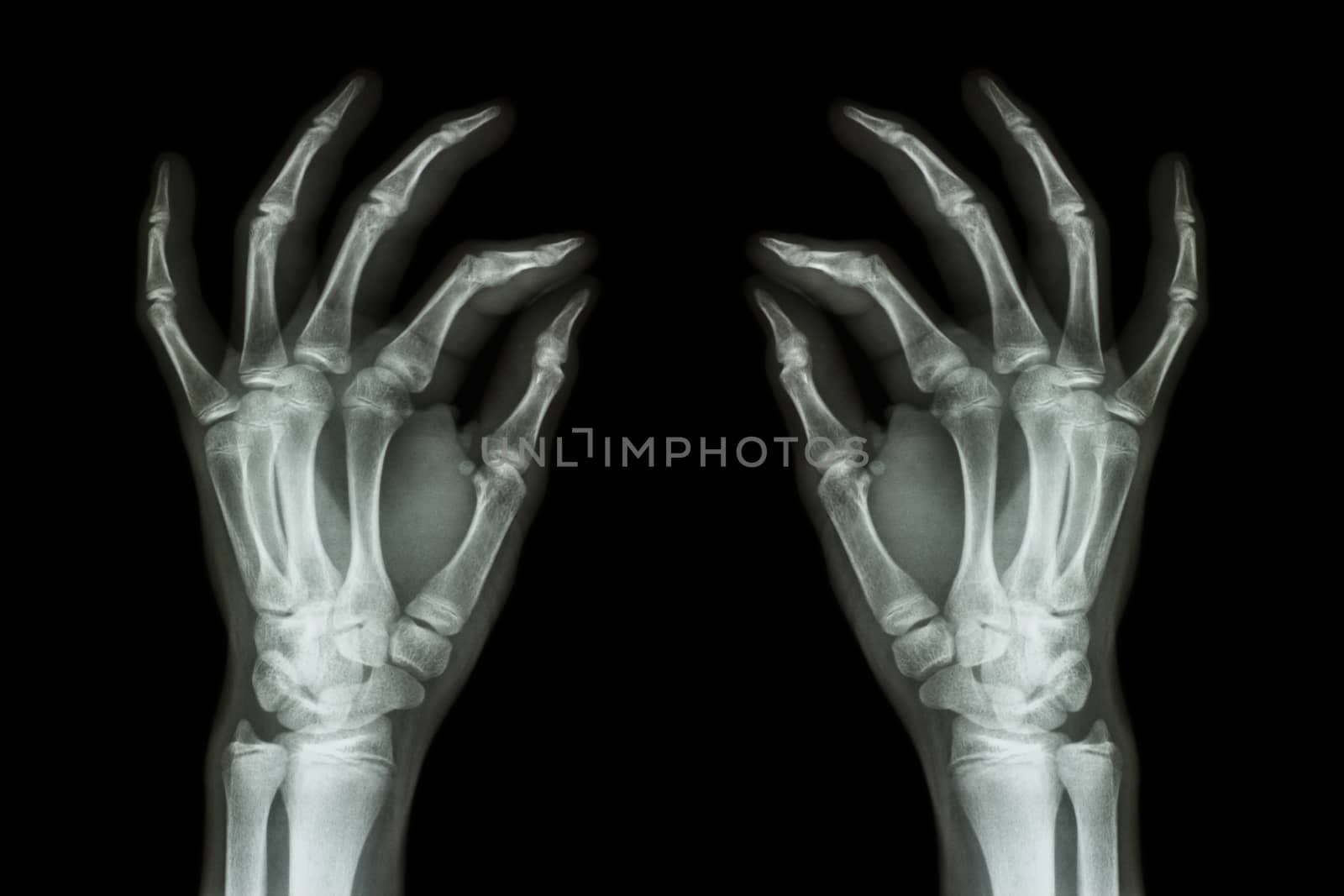 X-ray normal human hands (front) on black background