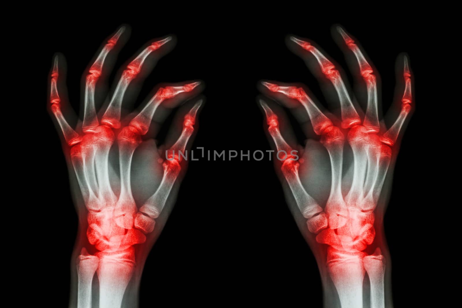 multiple joint arthritis both adult hands ( Gout , Rheumatoid ) on black background