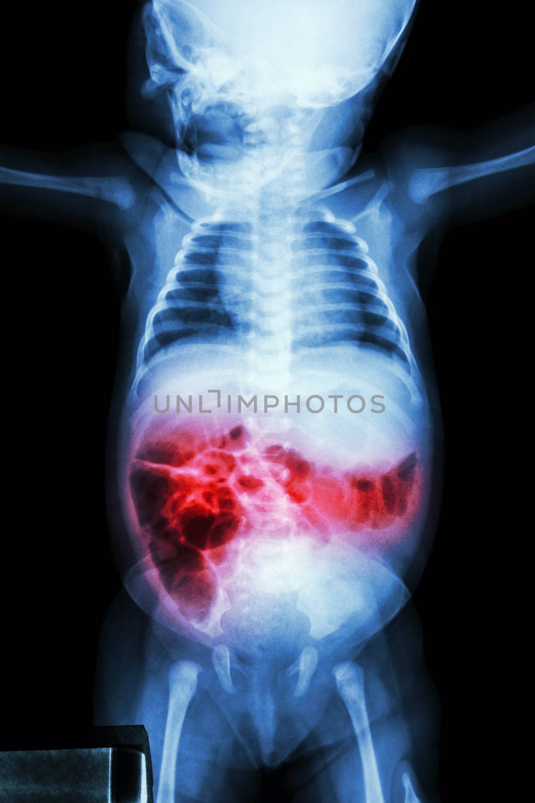 Enteritis (X-ray of sick infant and inflammation of intestine) by stockdevil