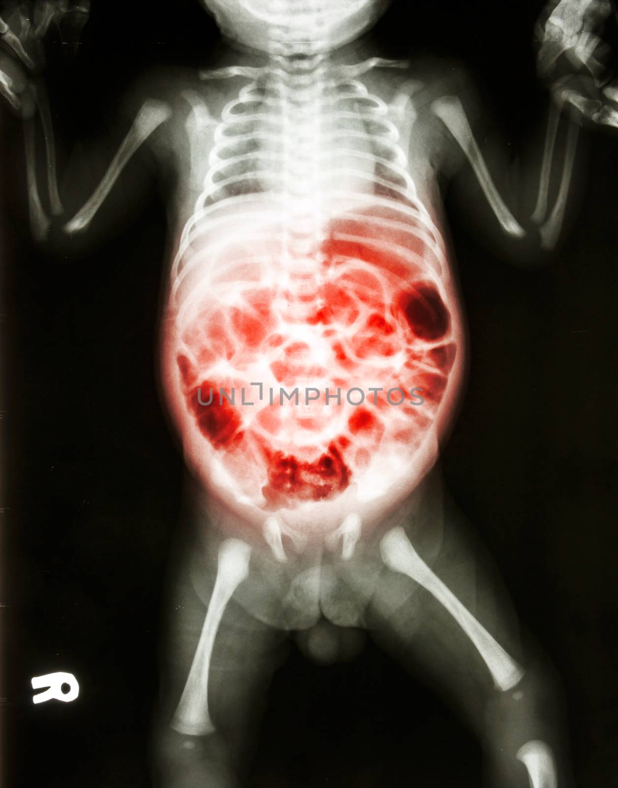 Enteritis (X-ray of sick infant and inflammation of intestine)