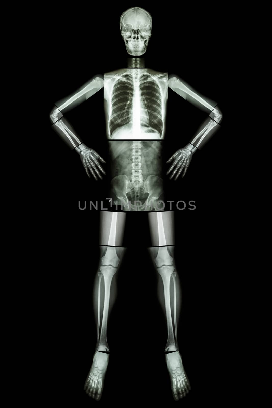 Human bone stand and akimbo (X-ray whole body : head skull neck spine shoulder arm elbow forearm wrist hand finger chest thorax heart lung abdomen back vertebra pelvis hip thigh knee leg ankle foot ) by stockdevil