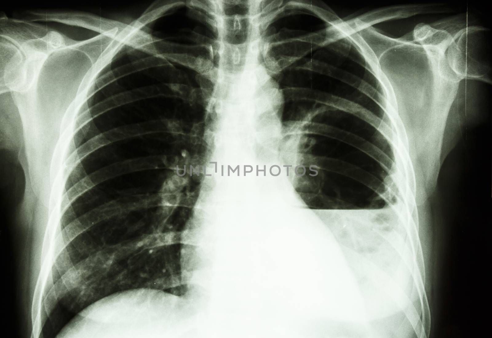 film X-ray show left lung abscess from Burkholderia pseudomallei infection (Mellioidosis)