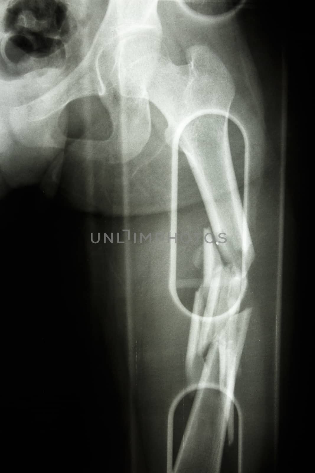 Film X-ray show comminute fracture shaft of femur
