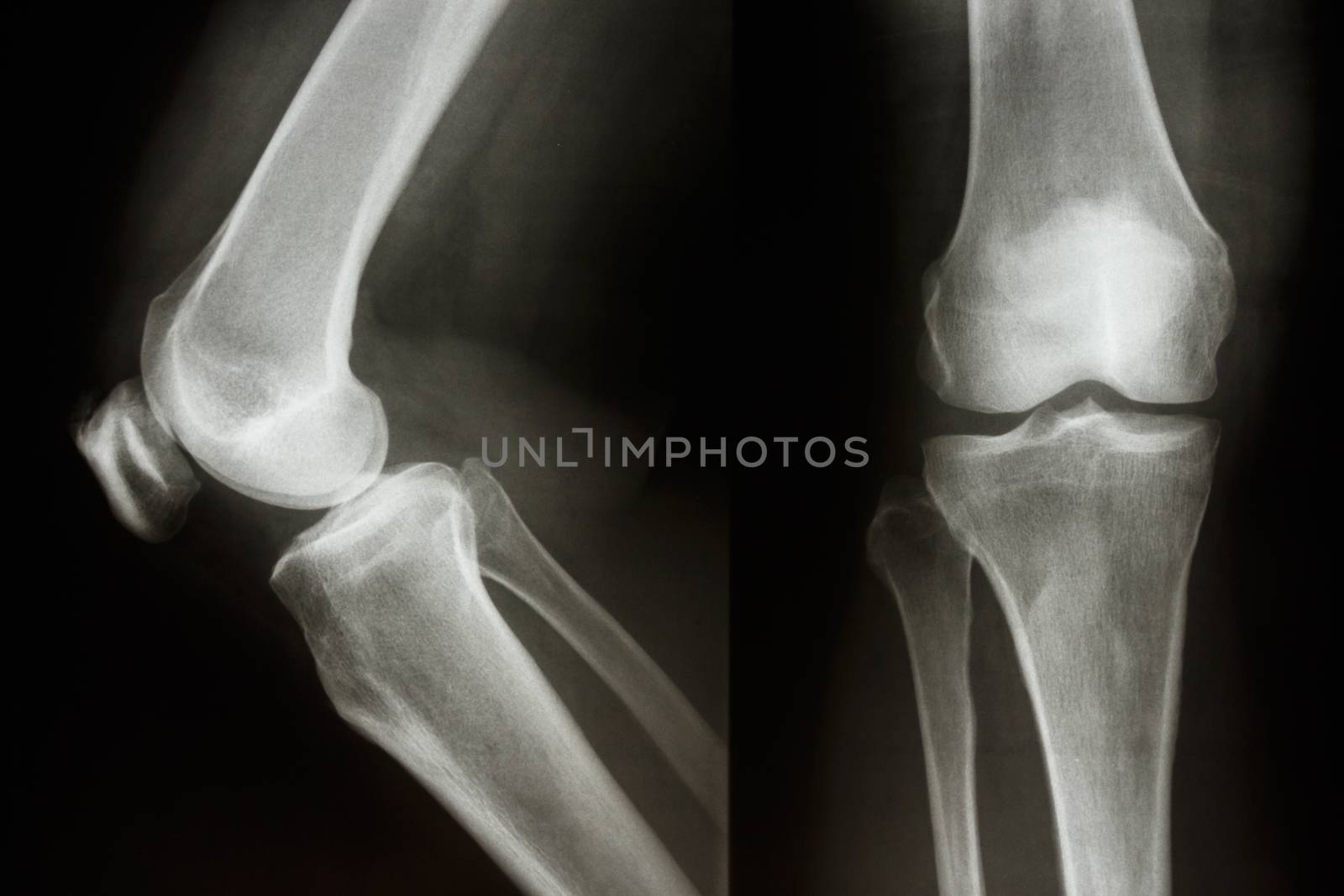 Film X-ray show normal knee joint(AP/Lateral)