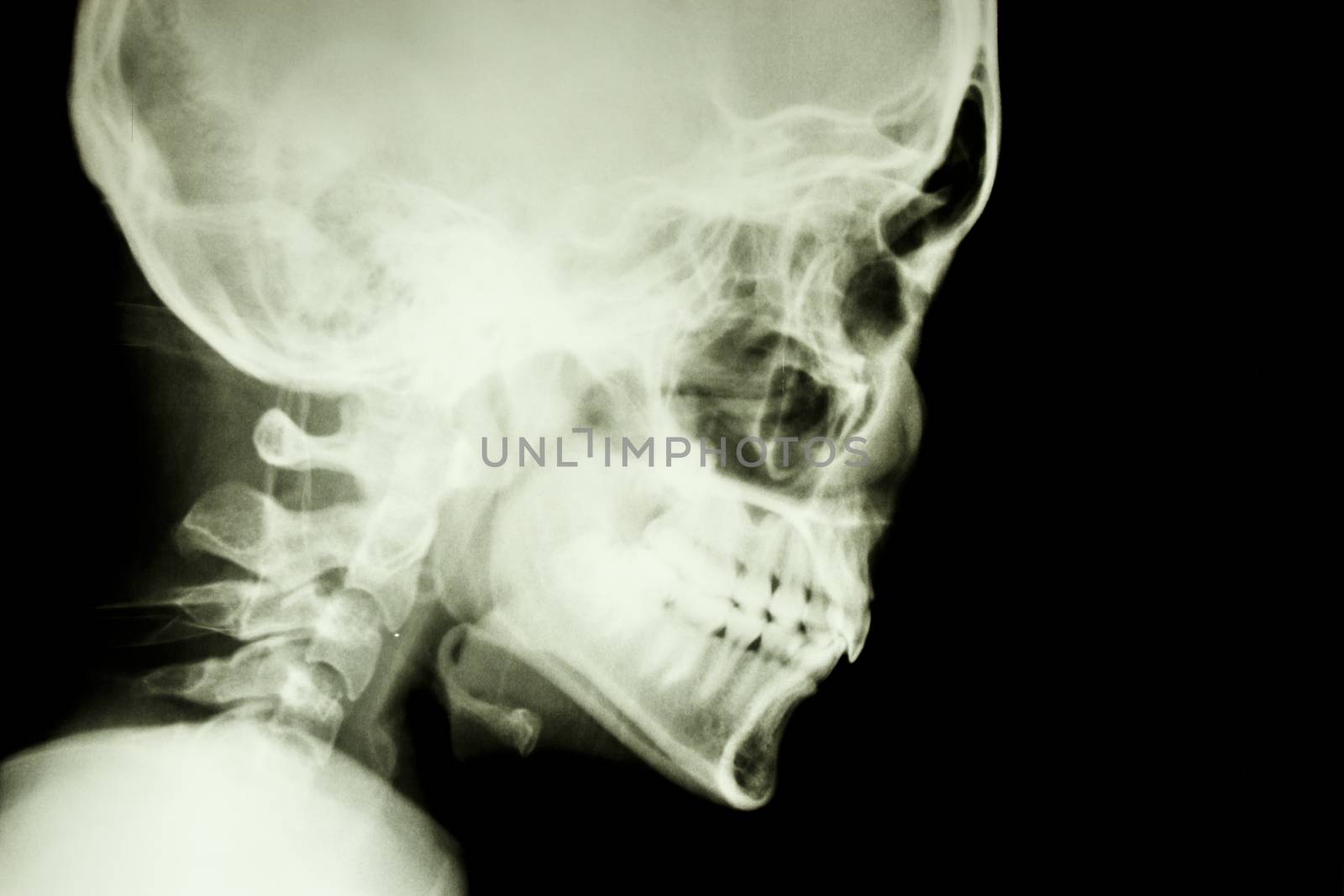 Film X-ray show normal skull and cervical spine in lateral side (isolated)