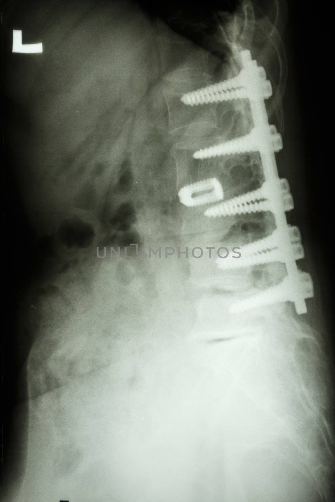 film X-ray show lumbar spine with pedicle screw fixation in spondylolithesis patient