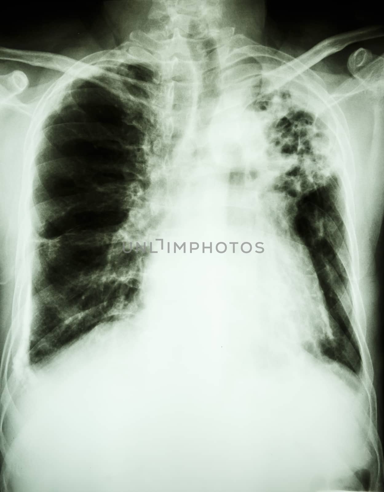 Film X-ray show patchy infiltrate at left upper lung from Mycobacterium tuberculosis infection (Pulmonary tuberculosis)