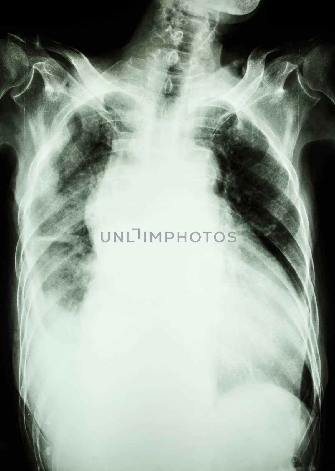 Film X-ray show infiltrate and effusion at right lung from Mycobacterium tuberculosis infection (Pulmonary tuberculosis)