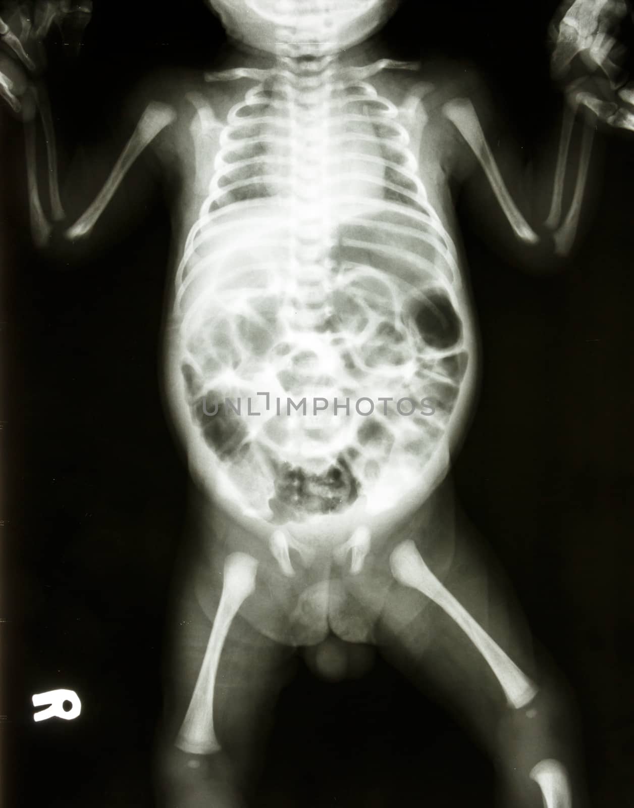 film X-ray show normal skeleton of infant