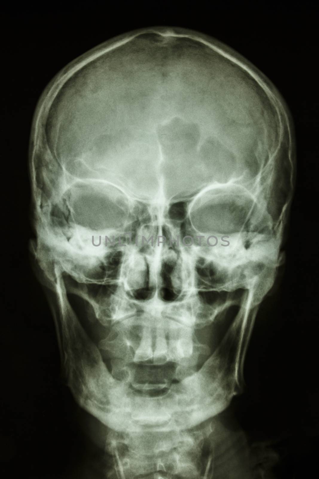 film skull AP(antero-posterior) show normal human skull