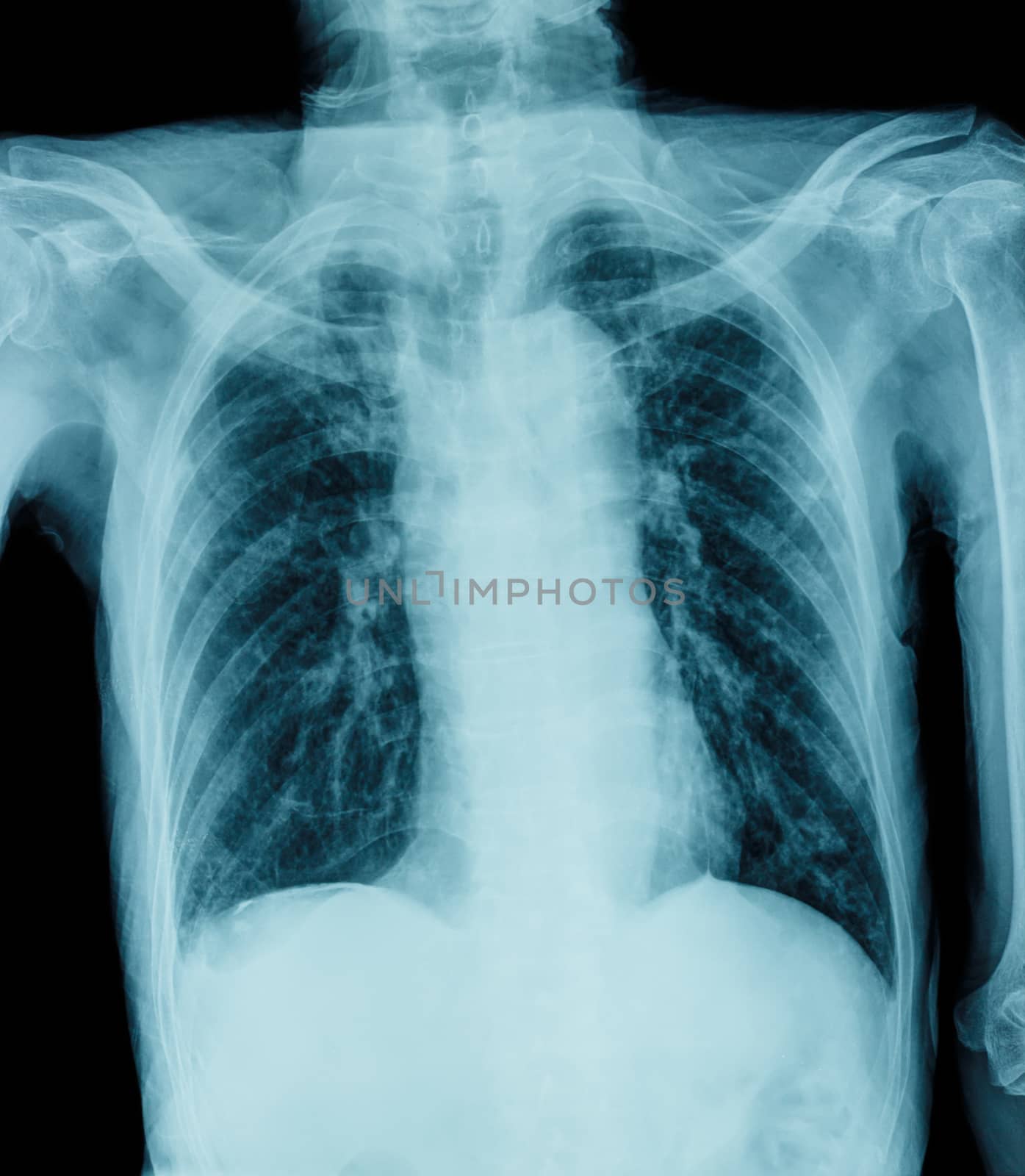 Film Chest X-ray show normal human's chest