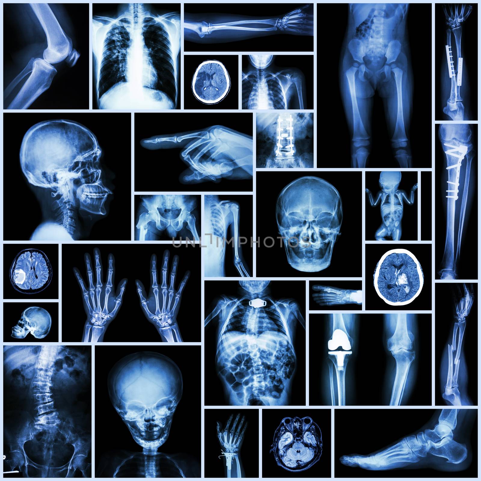 Collection X-ray "Multiple part of human,orthopedic surgery and multiple disease" (Fracture,Pulmonary by stockdevil