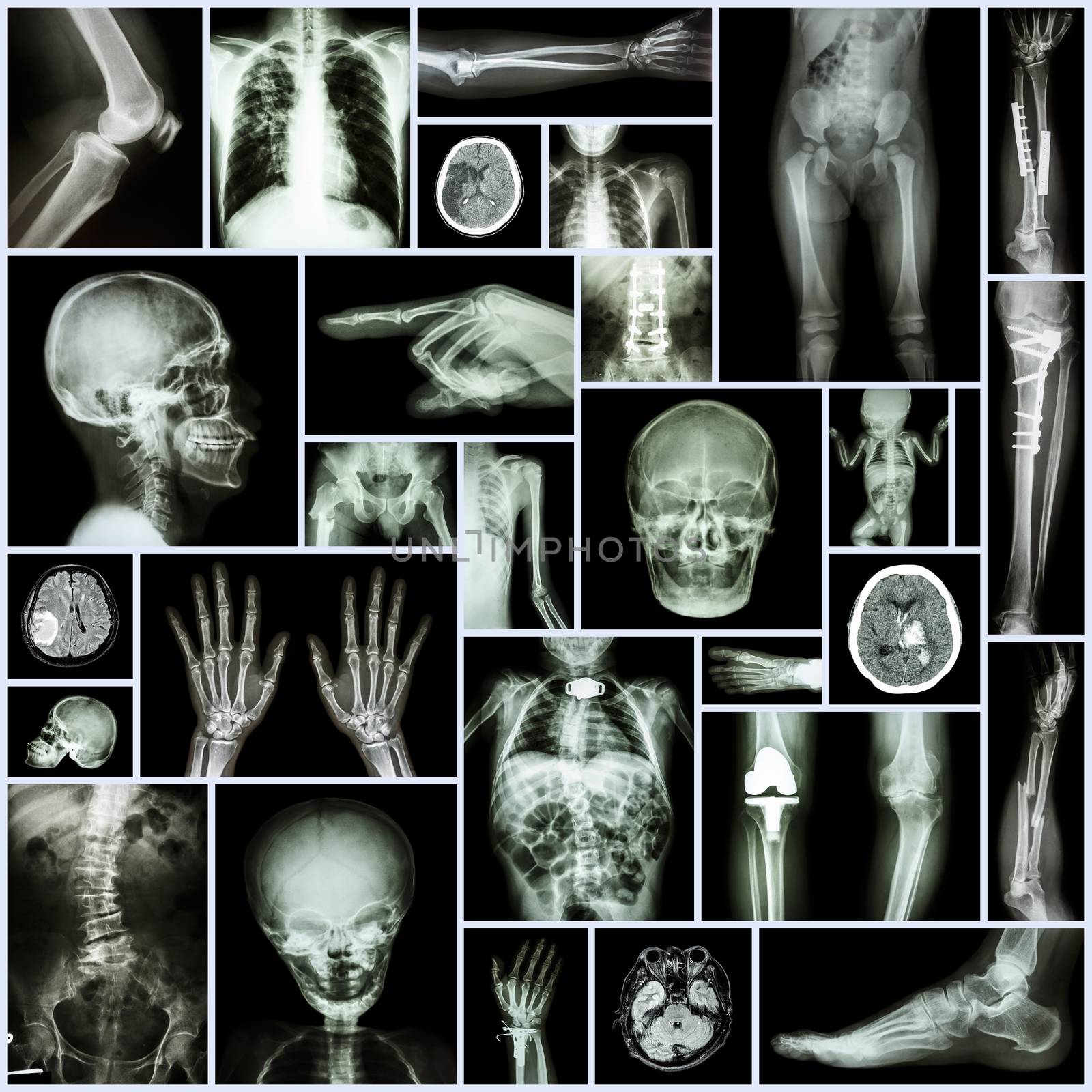 Collection X-ray "Multiple part of human,orthopedic surgery and multiple disease" (Fracture,Pulmonary